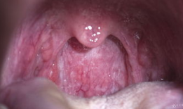 喉炎的图片,揭秘喉咙不适的警示信号